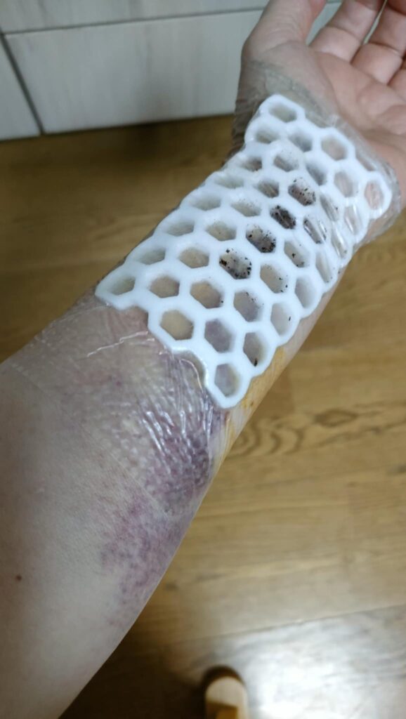 抜釘の時